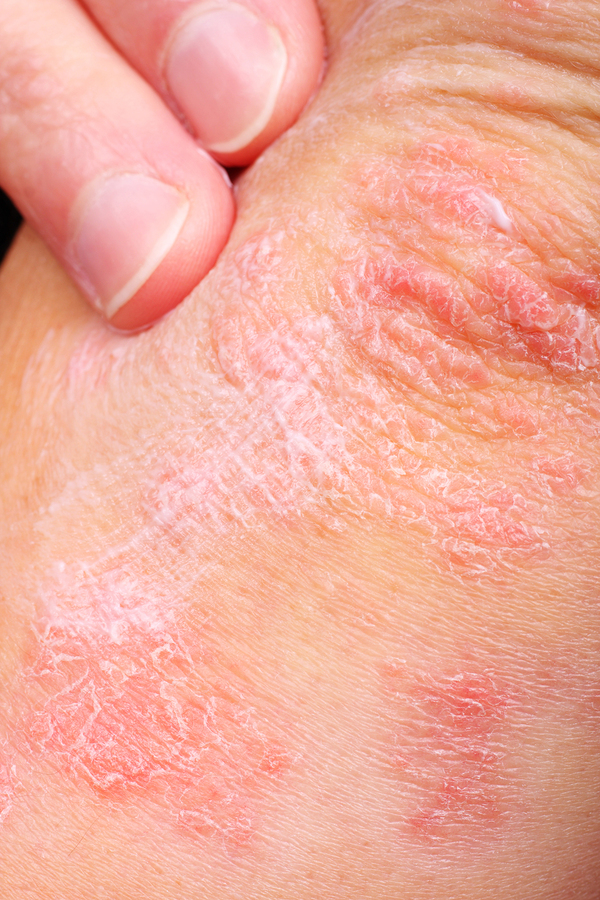 Psoriasis in Boise, ID
